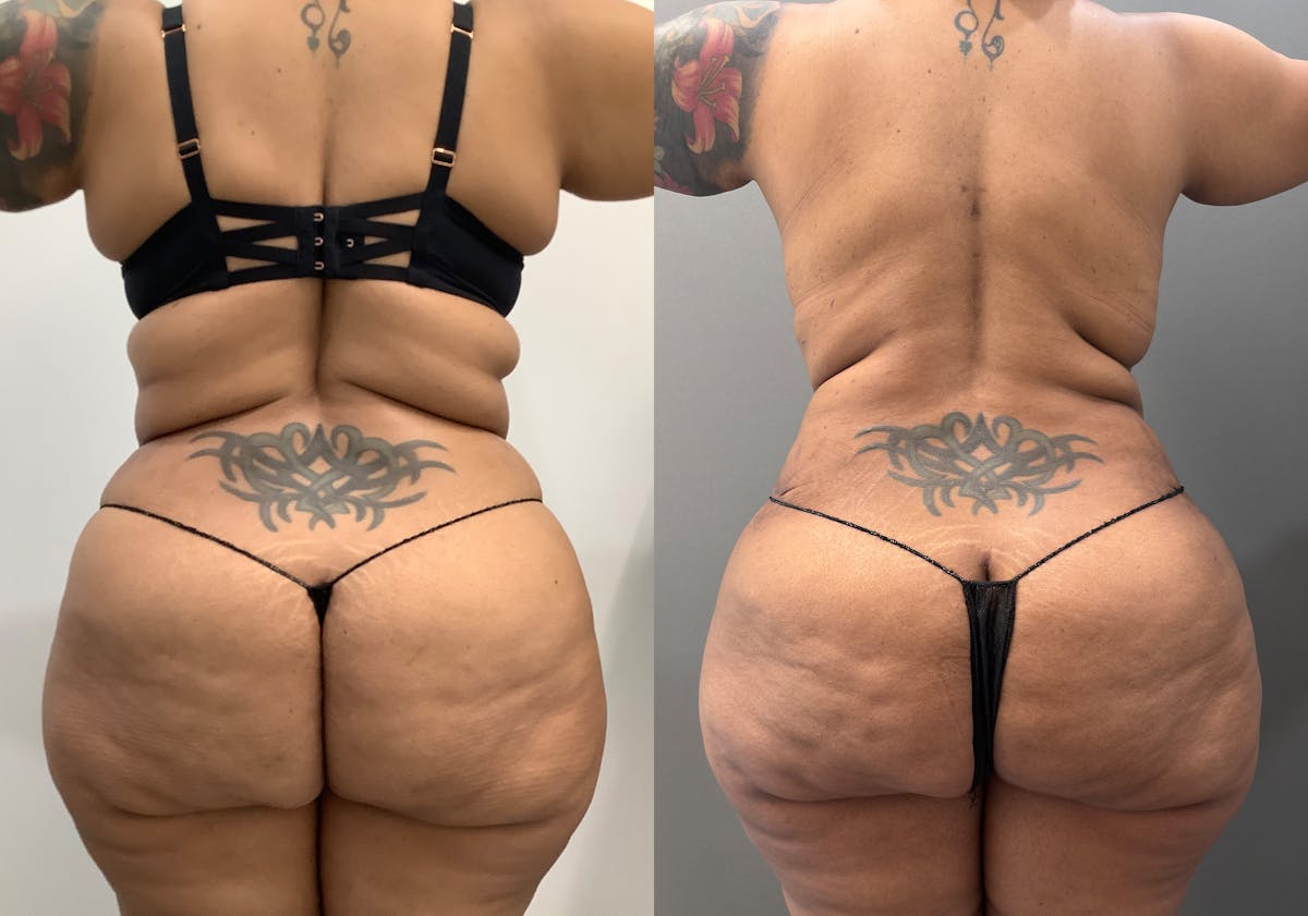 Liposuction Before & After Gallery - Patient 262528 - Image 5