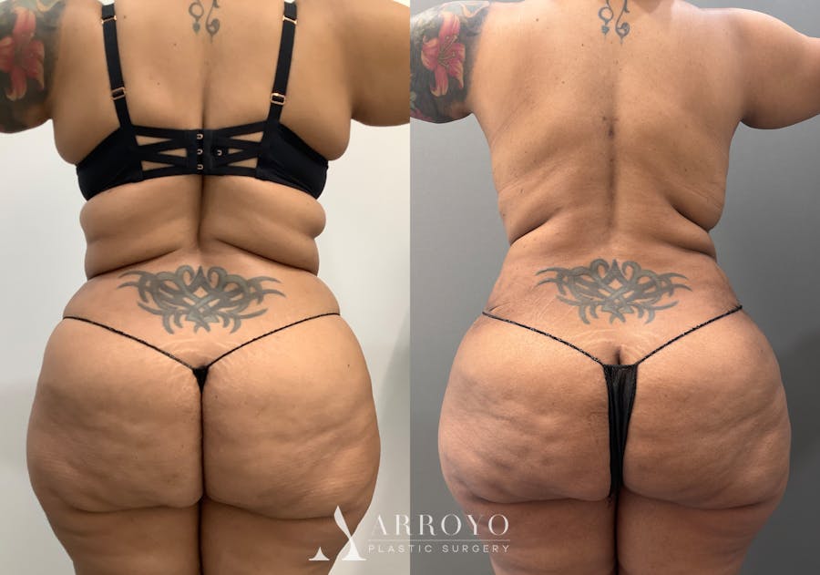 Tummy Tuck Before & After Gallery - Patient 706397 - Image 5