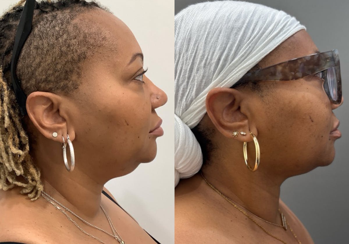 Neck Liposuction Before & After Gallery - Patient 820140 - Image 1