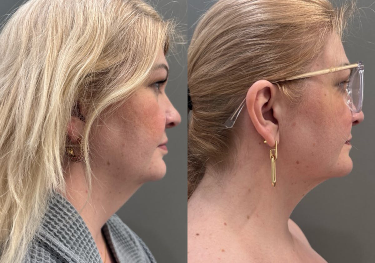 Neck Liposuction Before & After Gallery - Patient 368325 - Image 1