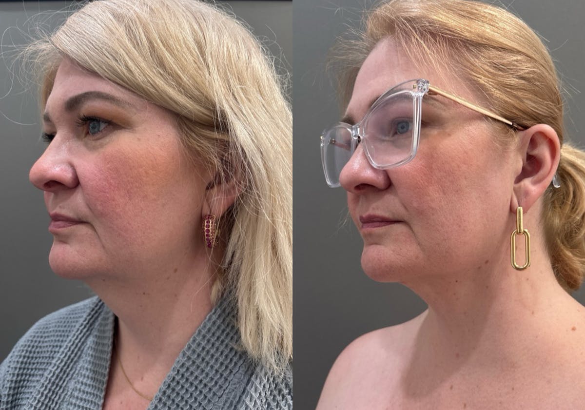 Neck Liposuction Before & After Gallery - Patient 368325 - Image 2