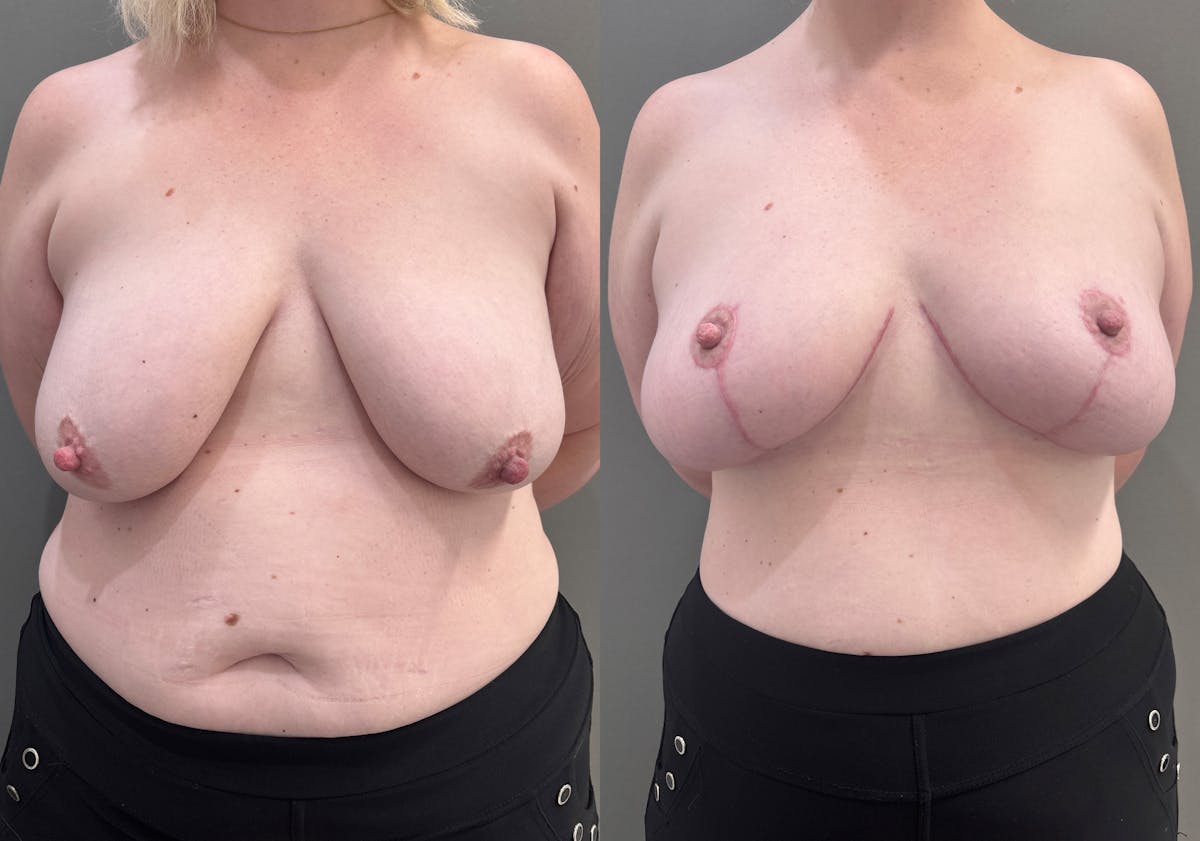 Breast Lift Before & After Gallery - Patient 183586 - Image 1