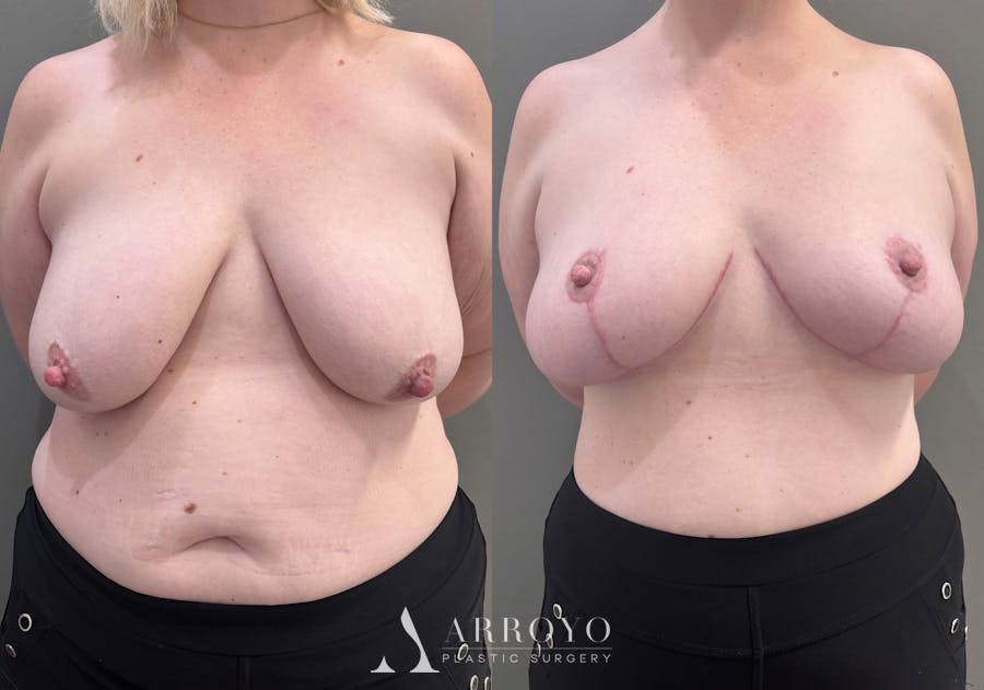 Breast Lift Before & After Gallery - Patient 183586 - Image 1