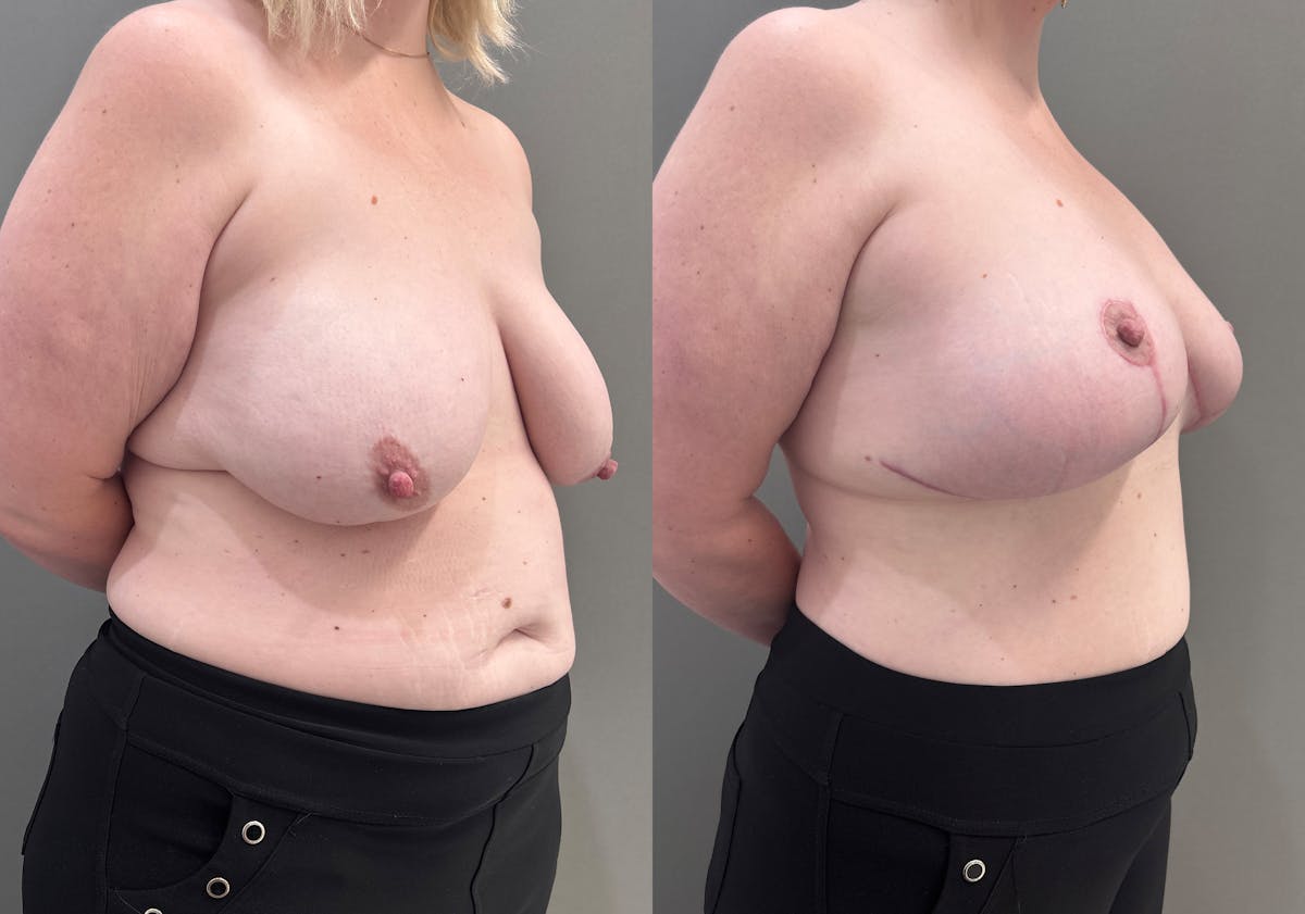 Breast Lift Before & After Gallery - Patient 183586 - Image 2