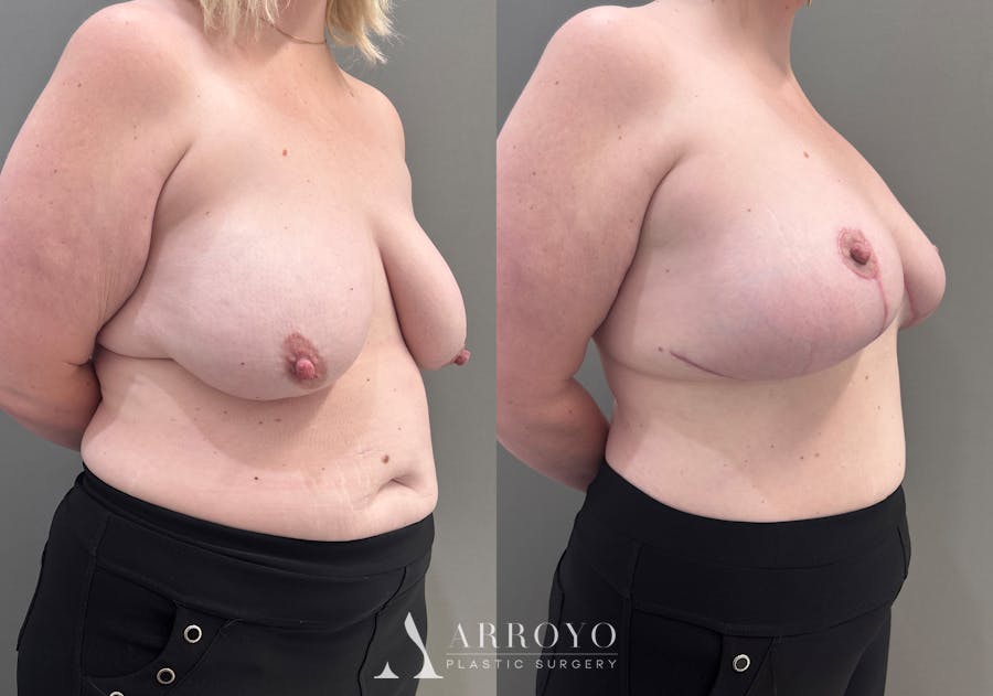 Breast Lift Before & After Gallery - Patient 183586 - Image 2