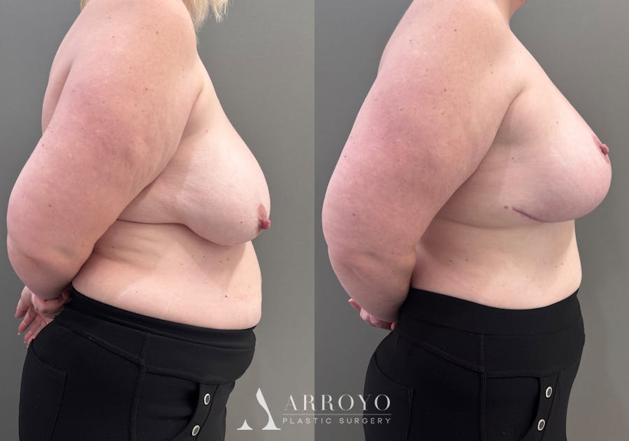 Breast Lift Before & After Gallery - Patient 183586 - Image 3