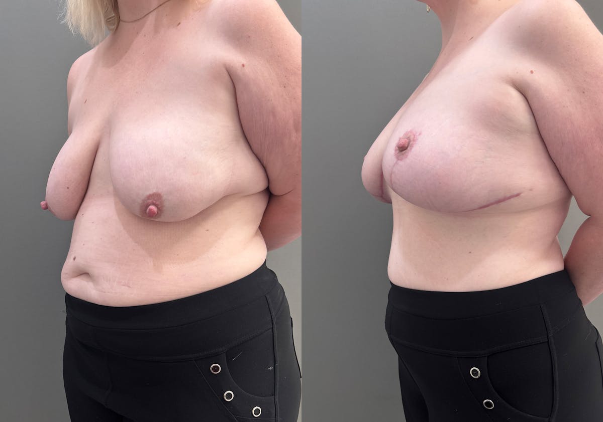 Breast Lift Before & After Gallery - Patient 183586 - Image 4