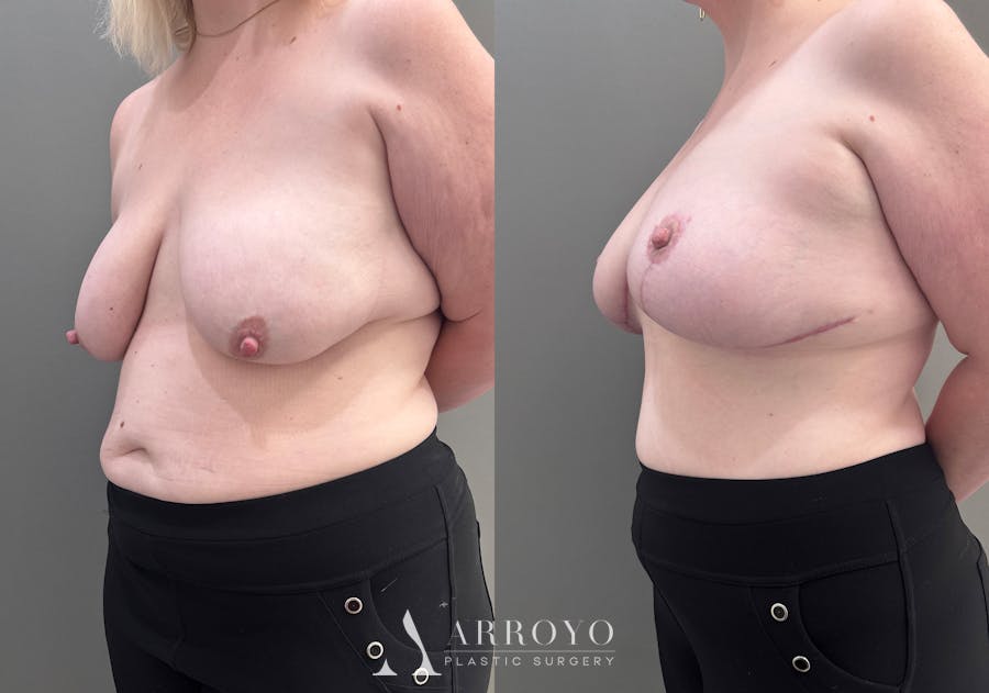 Breast Lift Before & After Gallery - Patient 183586 - Image 4