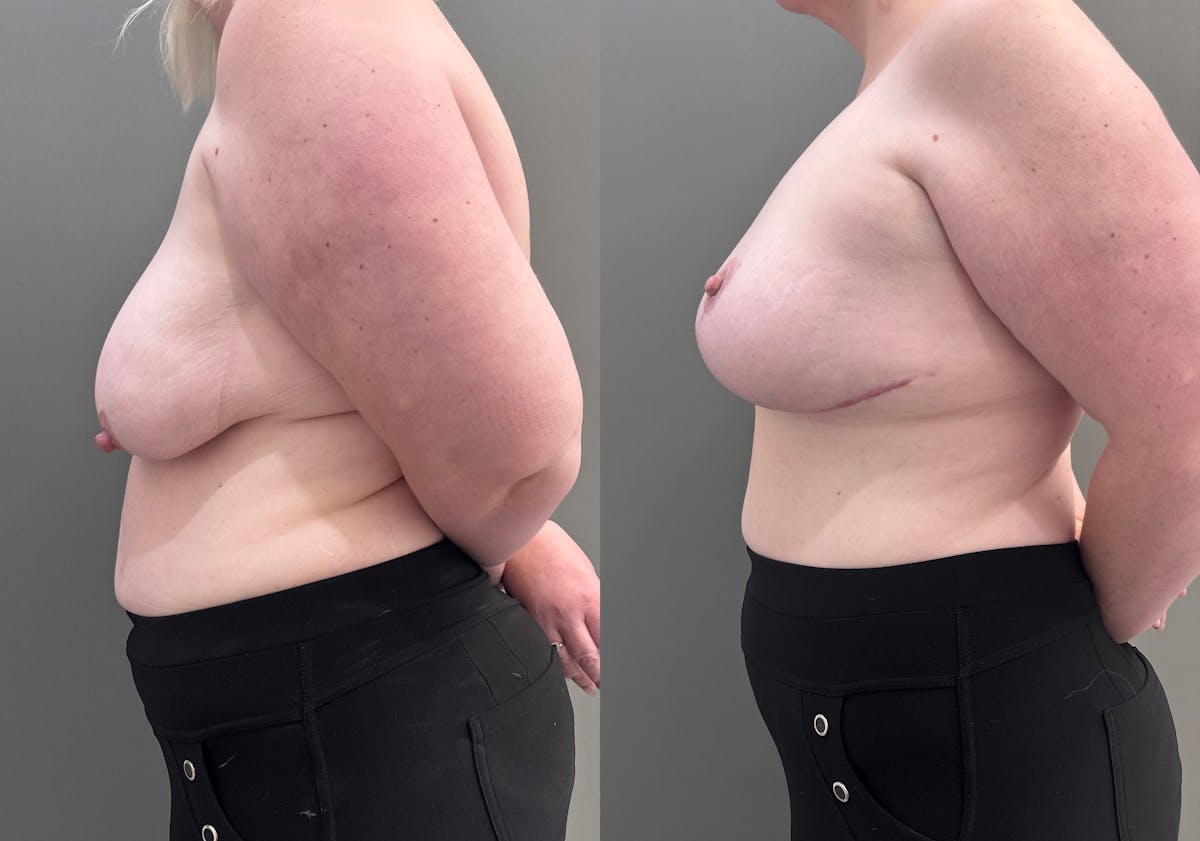 Breast Lift Before & After Gallery - Patient 183586 - Image 5