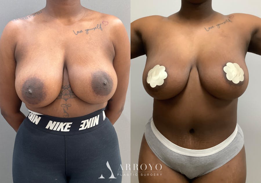 Tummy Tuck Before & After Gallery - Patient 186454 - Image 1