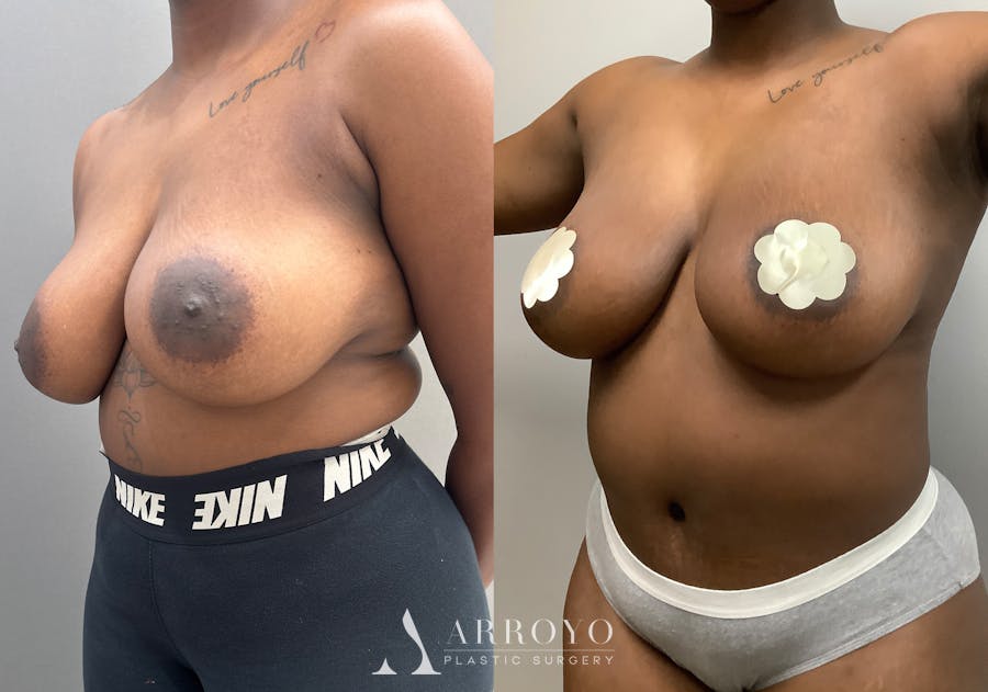 Tummy Tuck Before & After Gallery - Patient 186454 - Image 2
