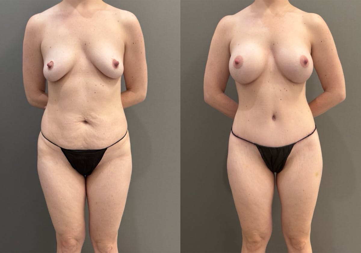 Body Lift Before & After Gallery - Patient 960508 - Image 1