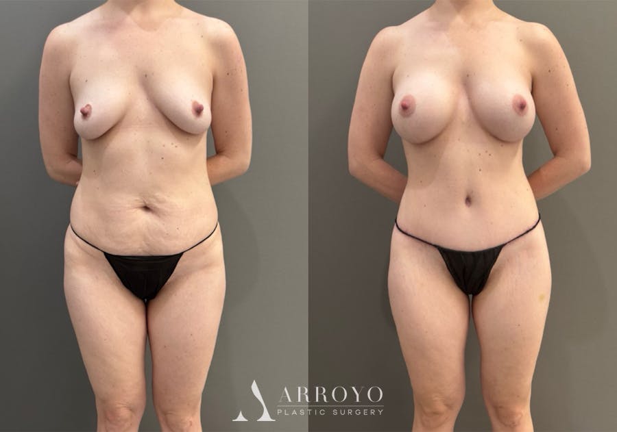 Body Lift Before & After Gallery - Patient 960508 - Image 1