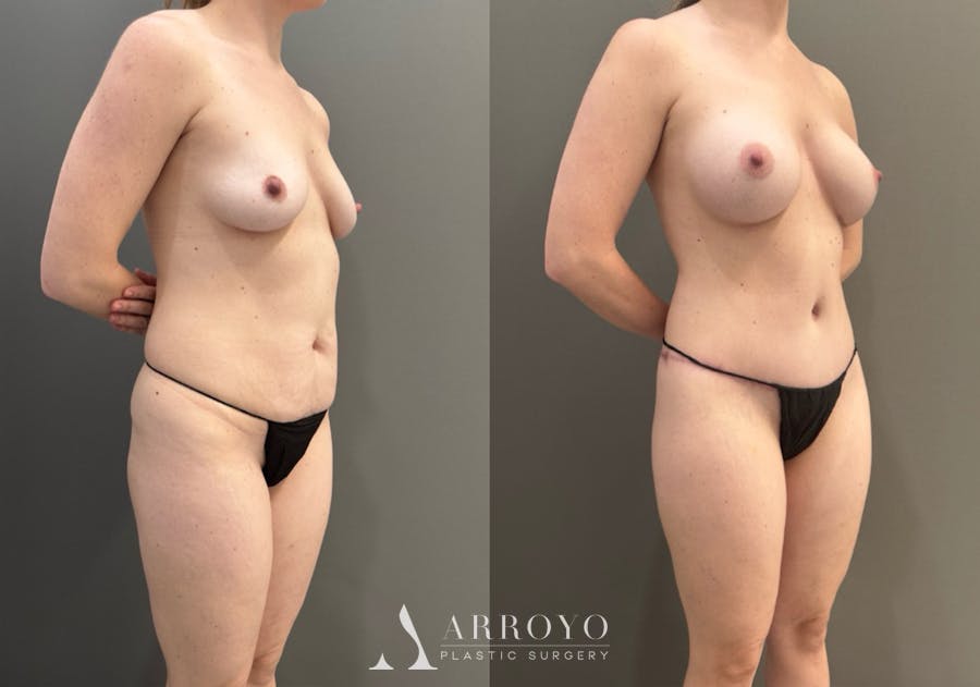 Body Lift Before & After Gallery - Patient 960508 - Image 2