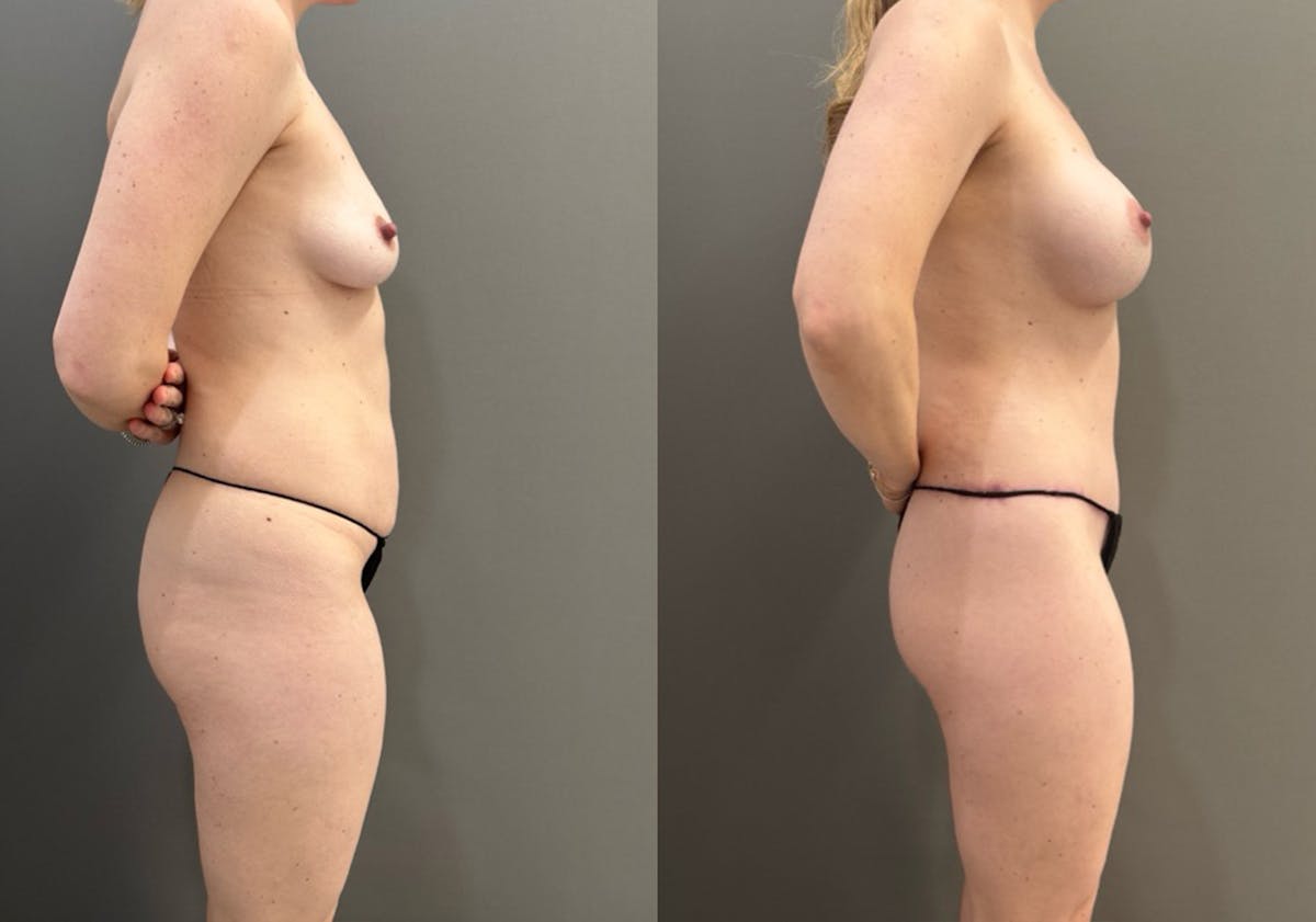 Body Lift Before & After Gallery - Patient 960508 - Image 3