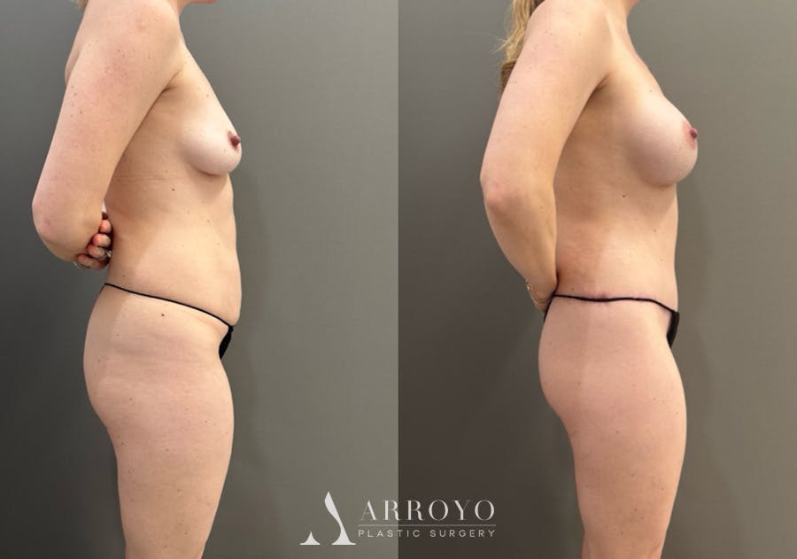 Body Lift Before & After Gallery - Patient 960508 - Image 3