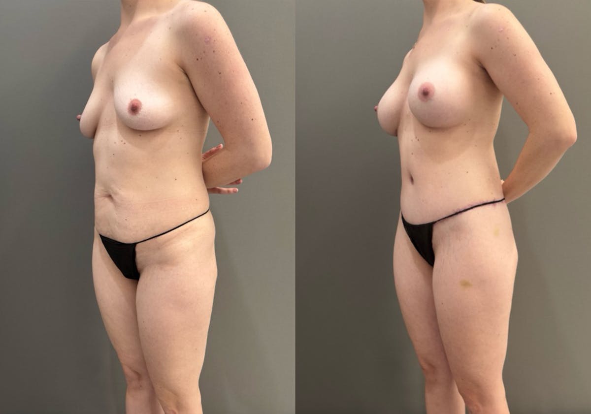 Body Lift Before & After Gallery - Patient 960508 - Image 4