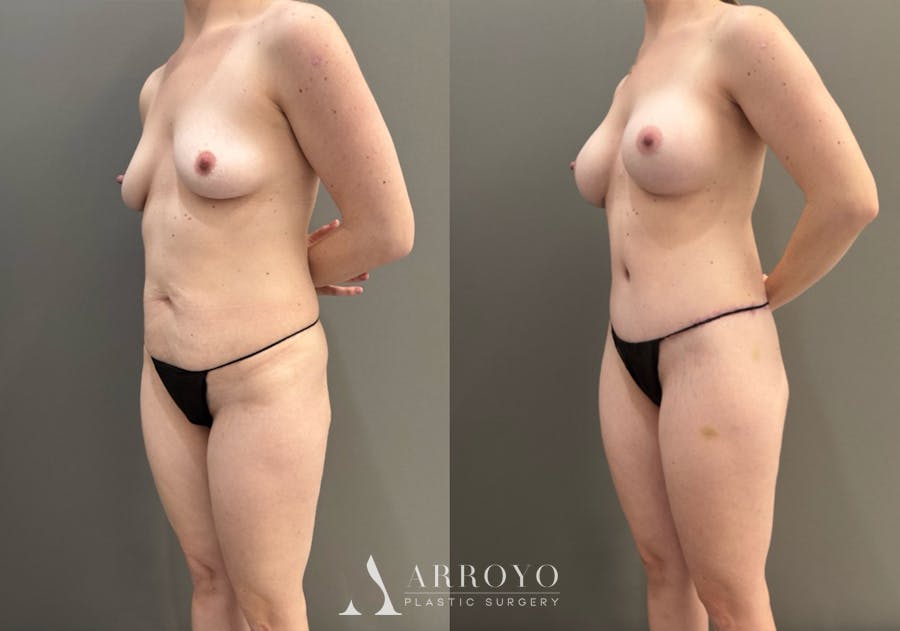 Body Lift Before & After Gallery - Patient 960508 - Image 4