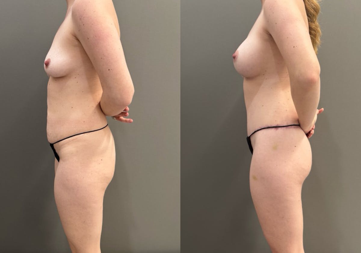 Body Lift Before & After Gallery - Patient 960508 - Image 5