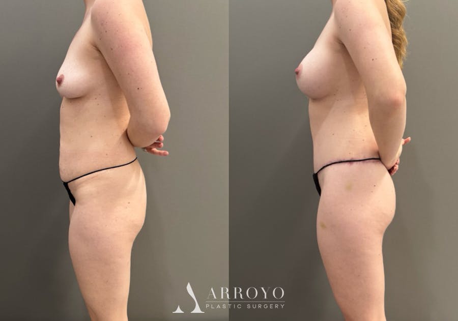 Body Lift Before & After Gallery - Patient 960508 - Image 5