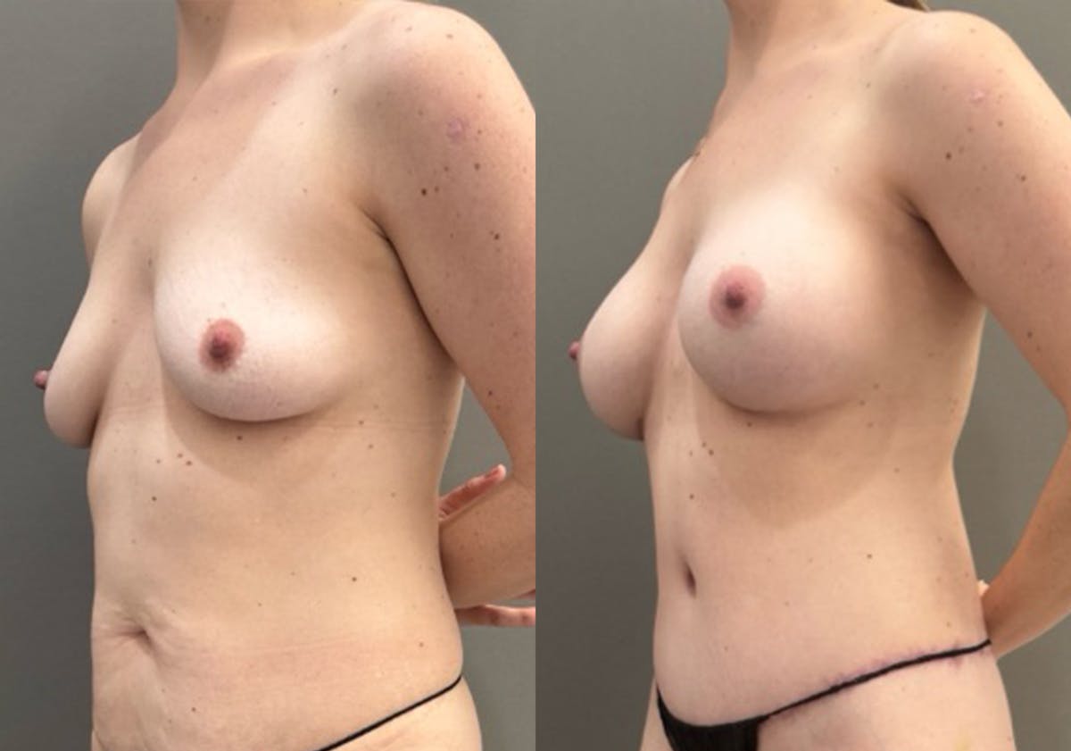 Breast Augmentation Before & After Gallery - Patient 721911 - Image 4