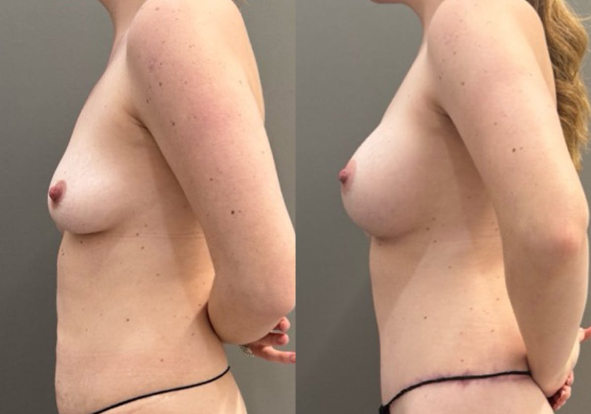 Breast Augmentation Before & After Gallery - Patient 721911 - Image 5