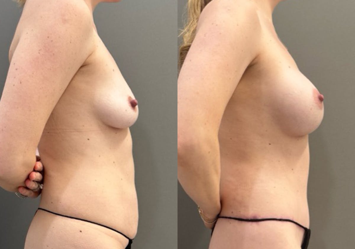 Breast Augmentation Before & After Gallery - Patient 721911 - Image 3