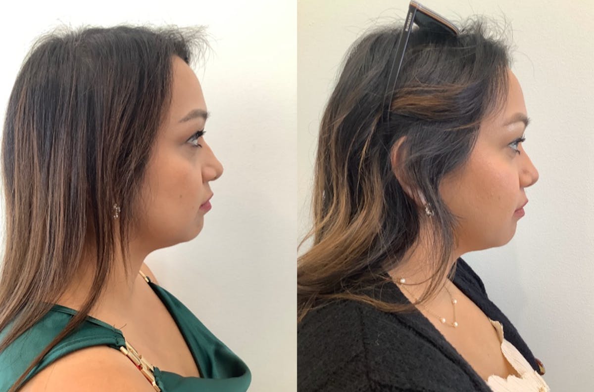 Rhinoplasty Before & After Gallery - Patient 530294 - Image 3