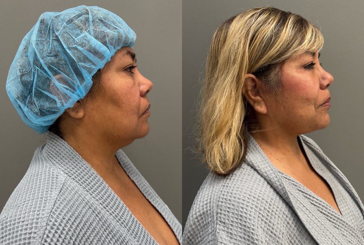 Facelift Before & After Gallery - Patient 126602 - Image 1