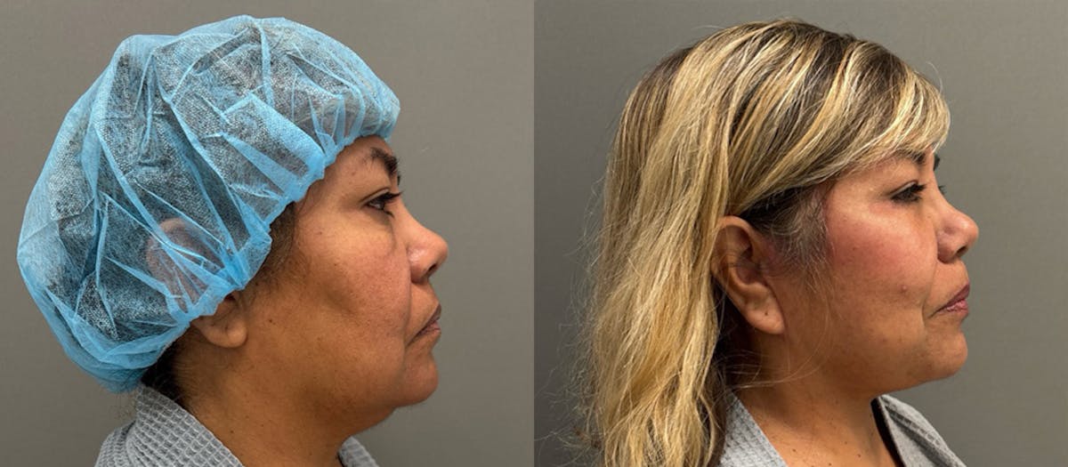 Blepharoplasty Before & After Gallery - Patient 283869 - Image 1