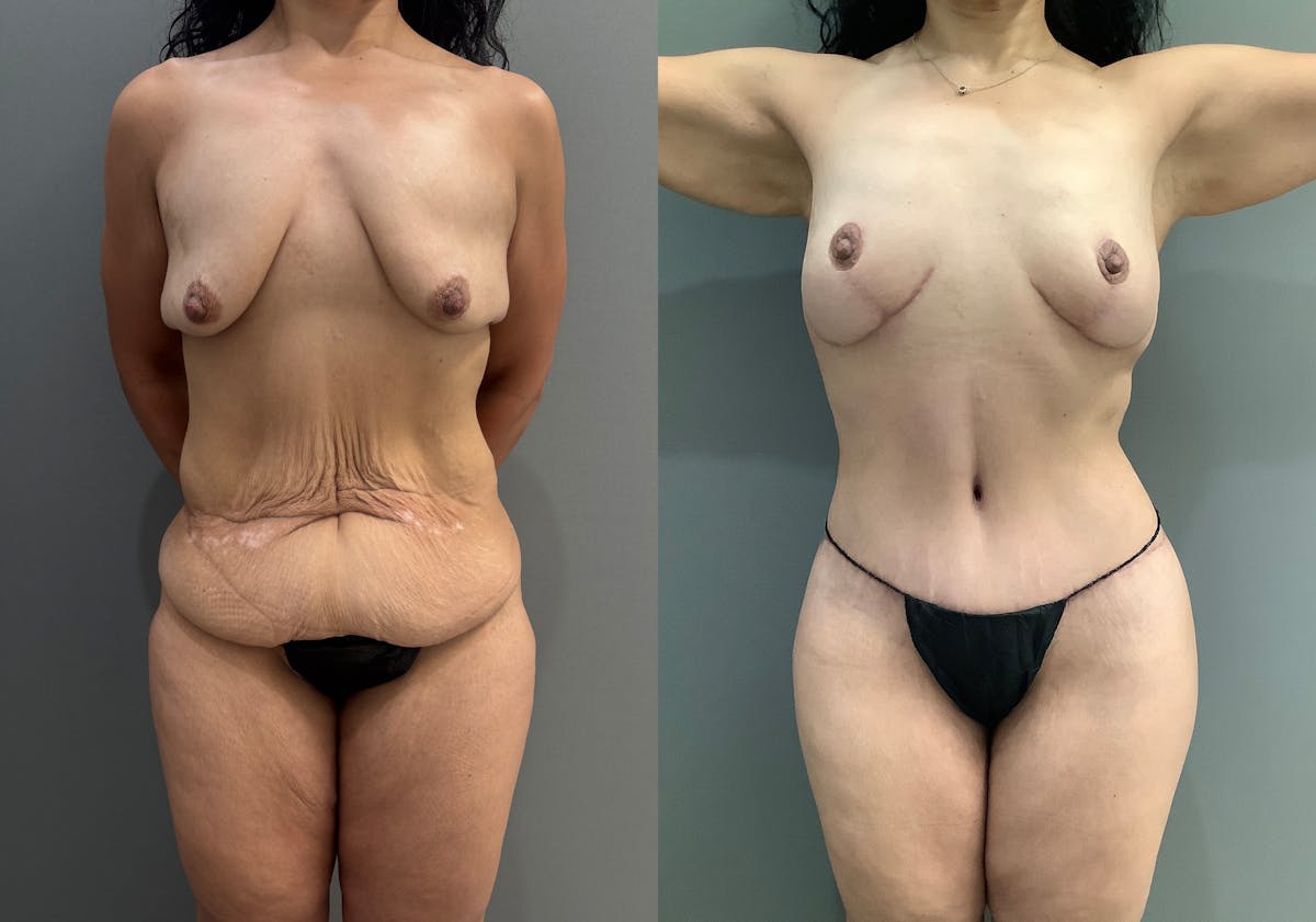 Breast Lift Before & After Gallery - Patient 419141 - Image 1