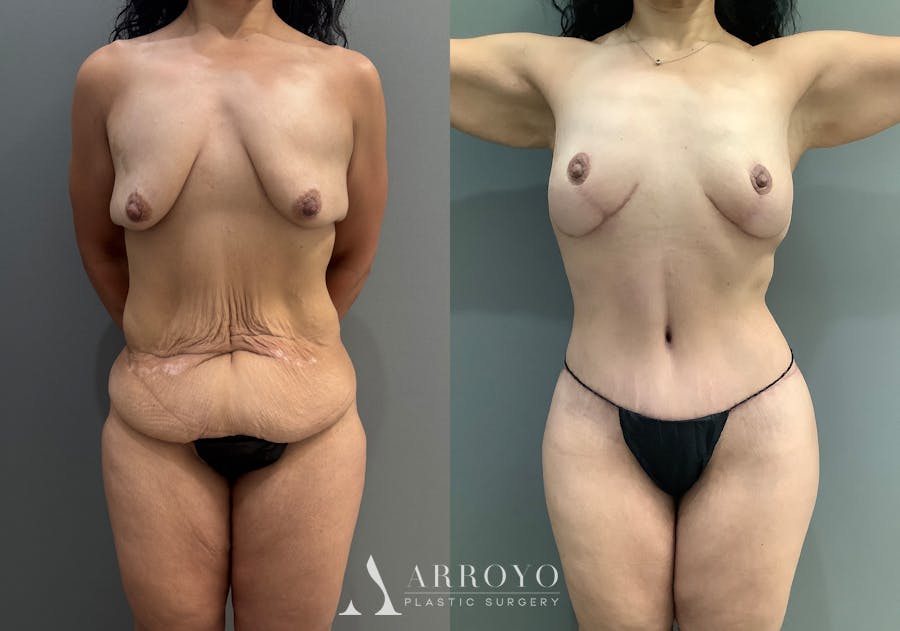 Body Lift Before & After Gallery - Patient 177587 - Image 1