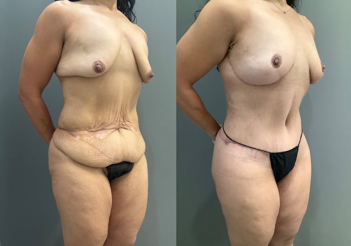 Breast Lift Before & After Gallery - Patient 419141 - Image 2