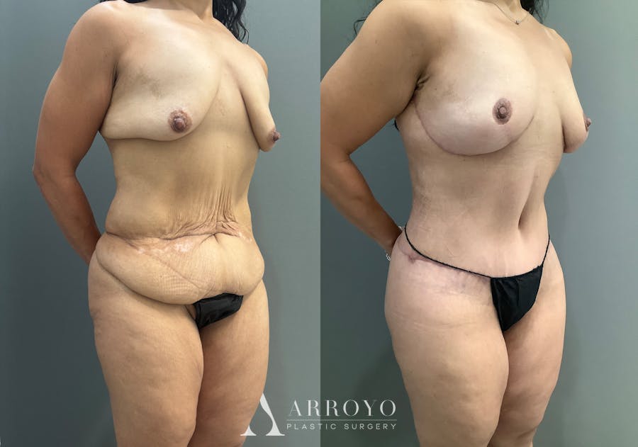 Body Lift Before & After Gallery - Patient 177587 - Image 2