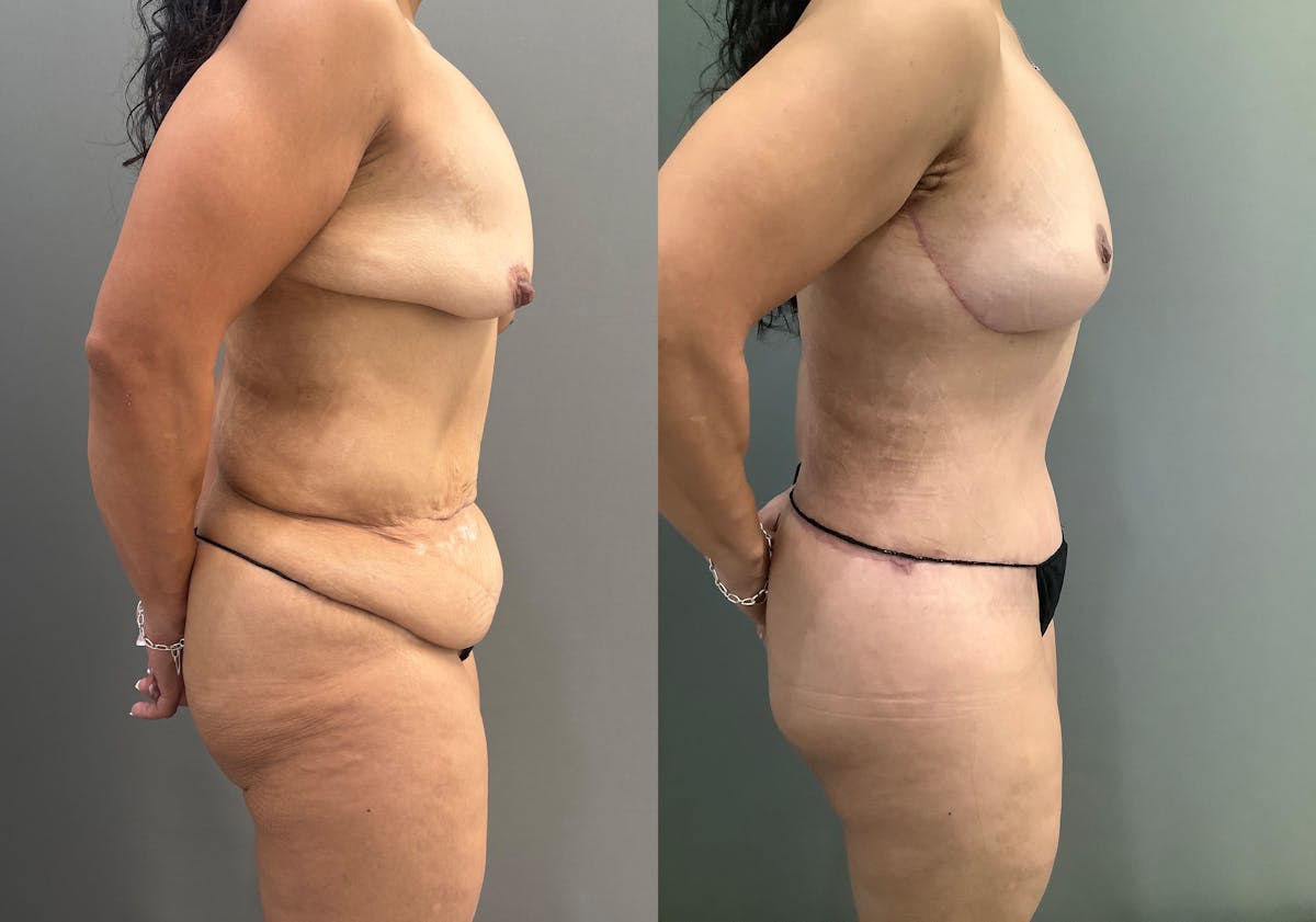 Breast Lift Before & After Gallery - Patient 419141 - Image 3