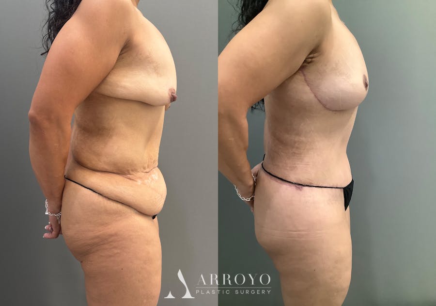 Body Lift Before & After Gallery - Patient 177587 - Image 3