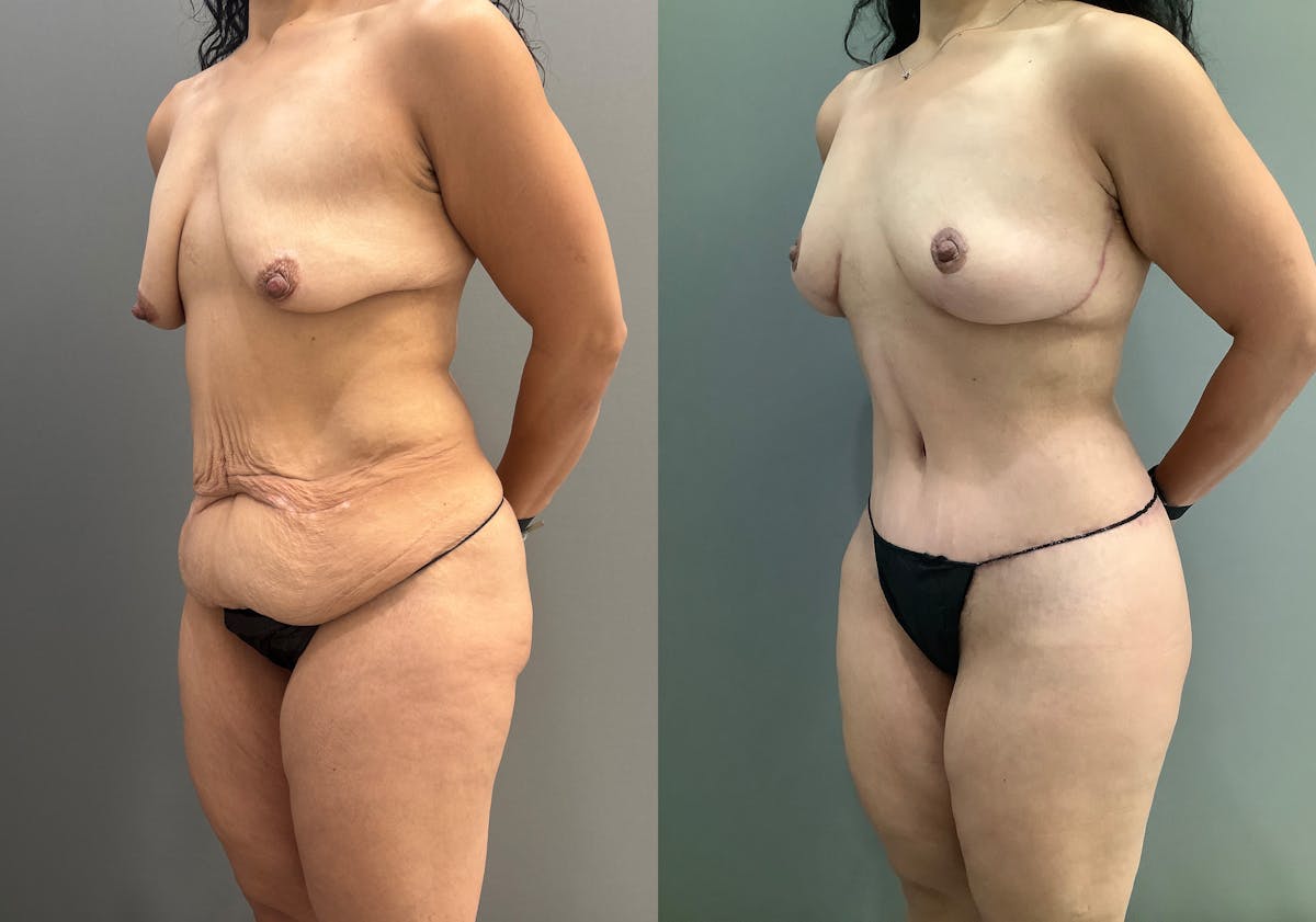 Breast Lift Before & After Gallery - Patient 419141 - Image 4
