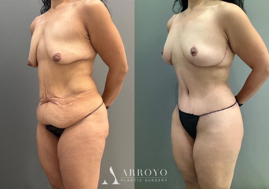 Body Lift Before & After Gallery - Patient 177587 - Image 4
