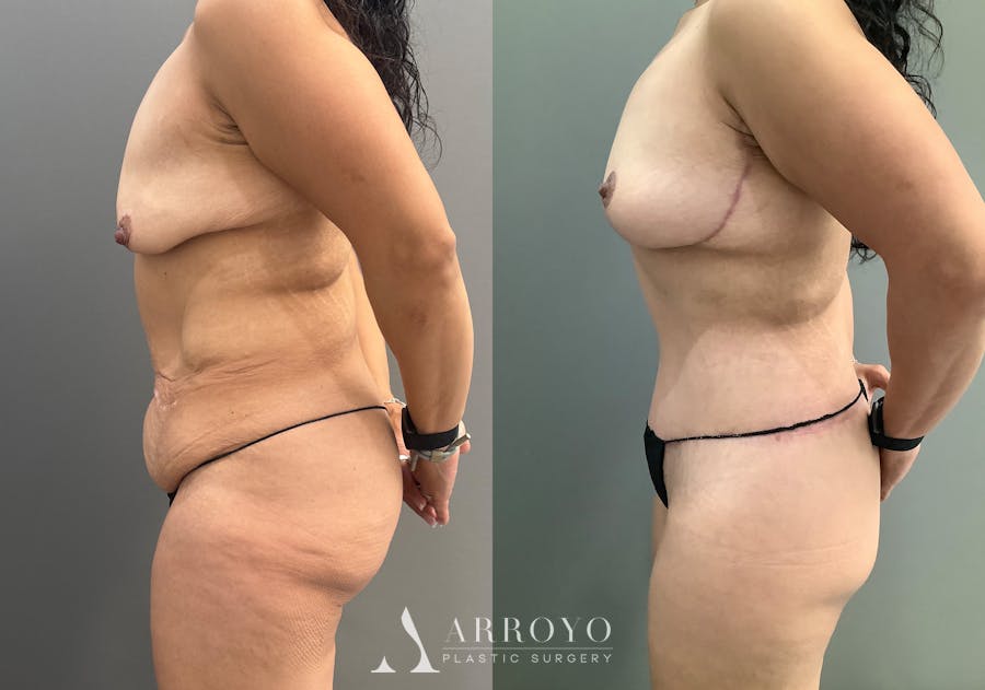 Body Lift Before & After Gallery - Patient 177587 - Image 5