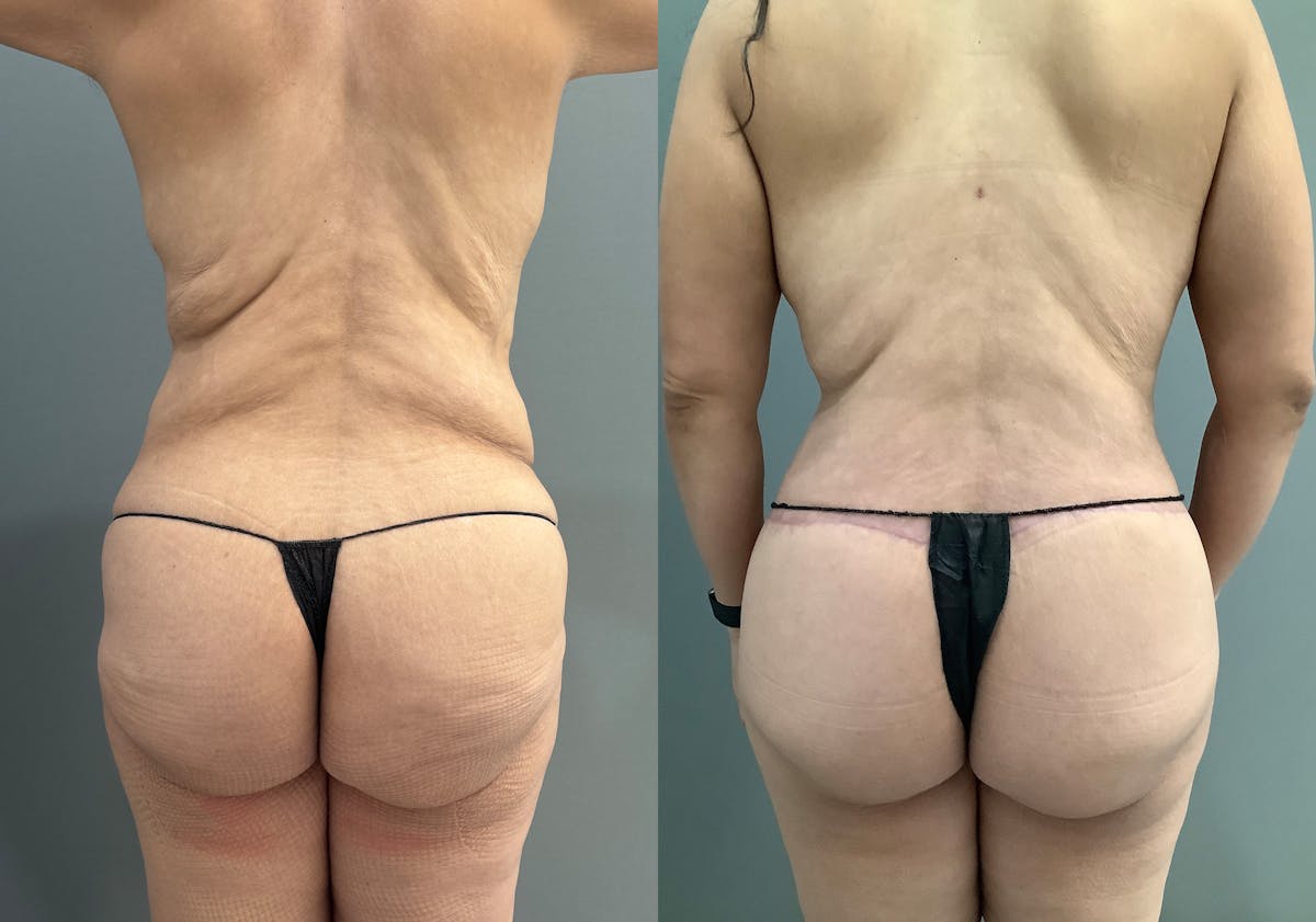 Breast Lift Before & After Gallery - Patient 419141 - Image 6