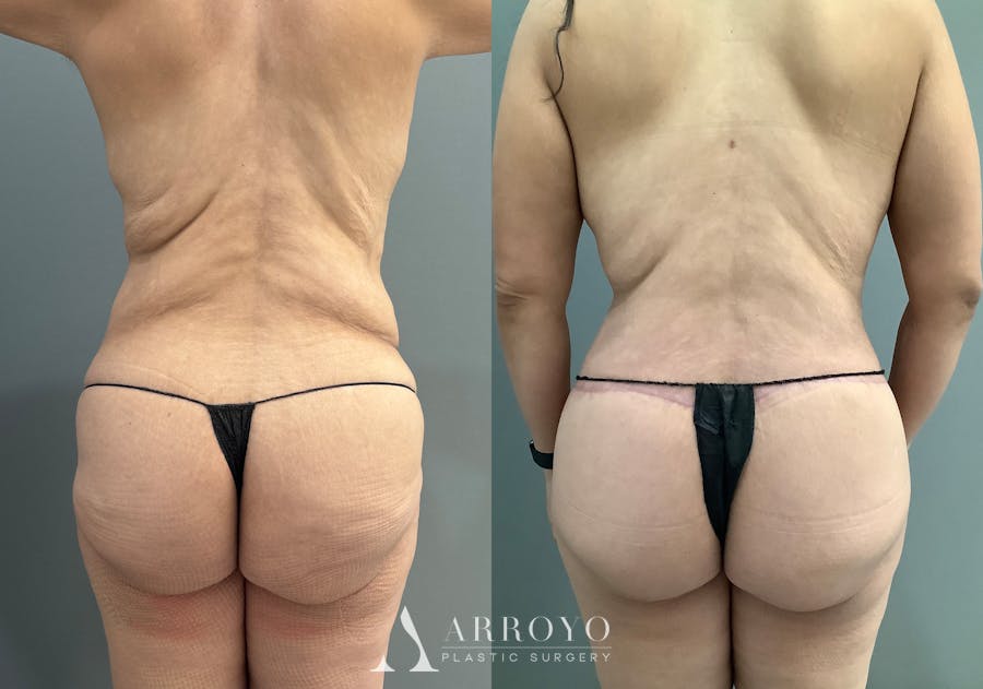 Body Lift Before & After Gallery - Patient 177587 - Image 6