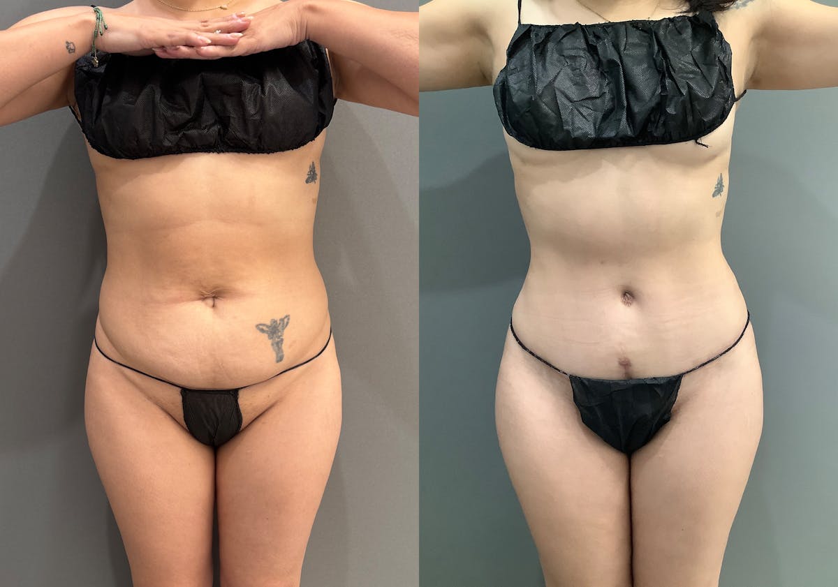 Liposuction Before & After Gallery - Patient 314443 - Image 1