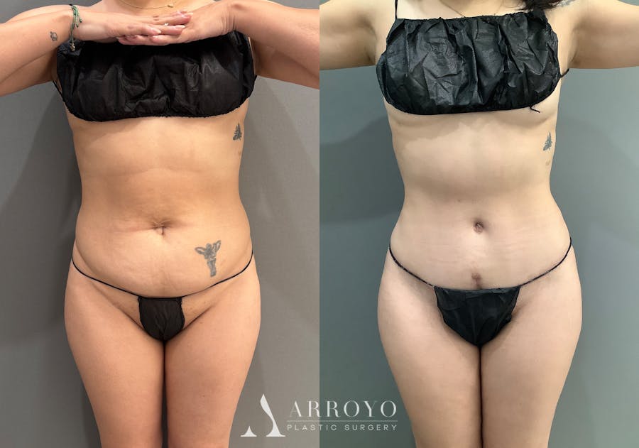 Liposuction Before & After Gallery - Patient 314443 - Image 1