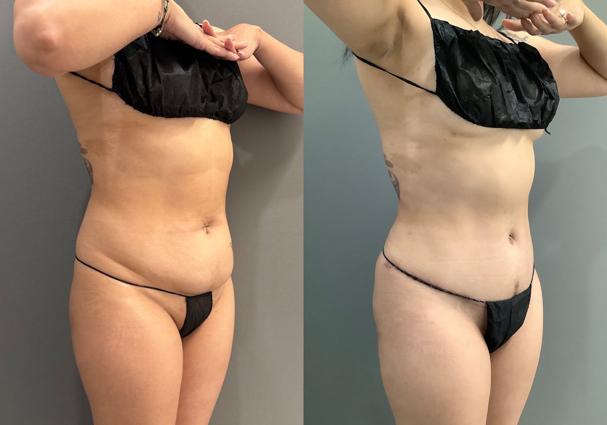 Liposuction Before & After Gallery - Patient 314443 - Image 2