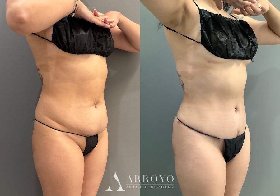 Liposuction Before & After Gallery - Patient 314443 - Image 2