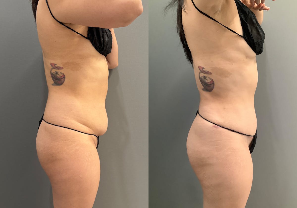 Liposuction Before & After Gallery - Patient 314443 - Image 3
