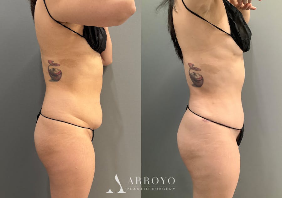 Liposuction Before & After Gallery - Patient 314443 - Image 3