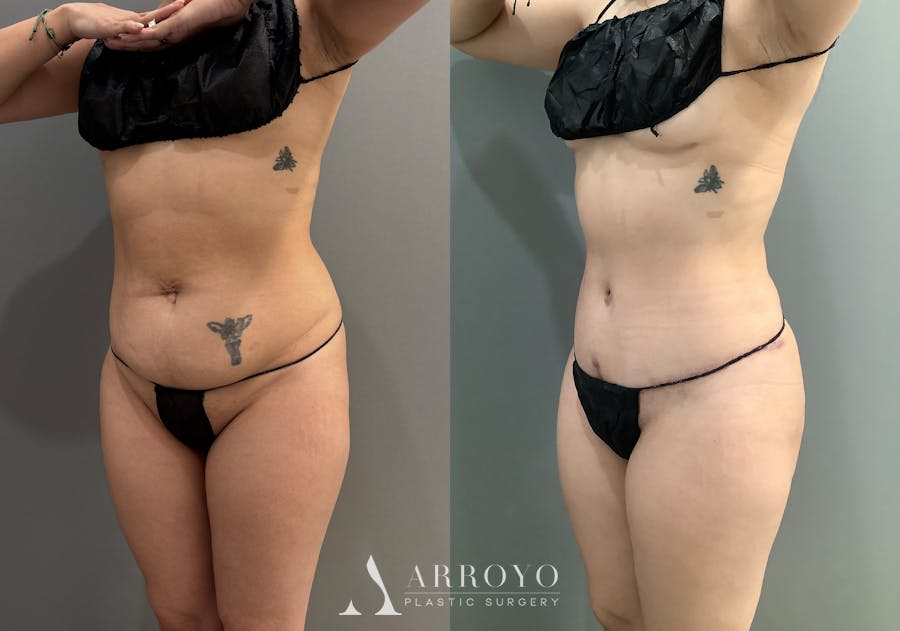 Liposuction Before & After Gallery - Patient 314443 - Image 4