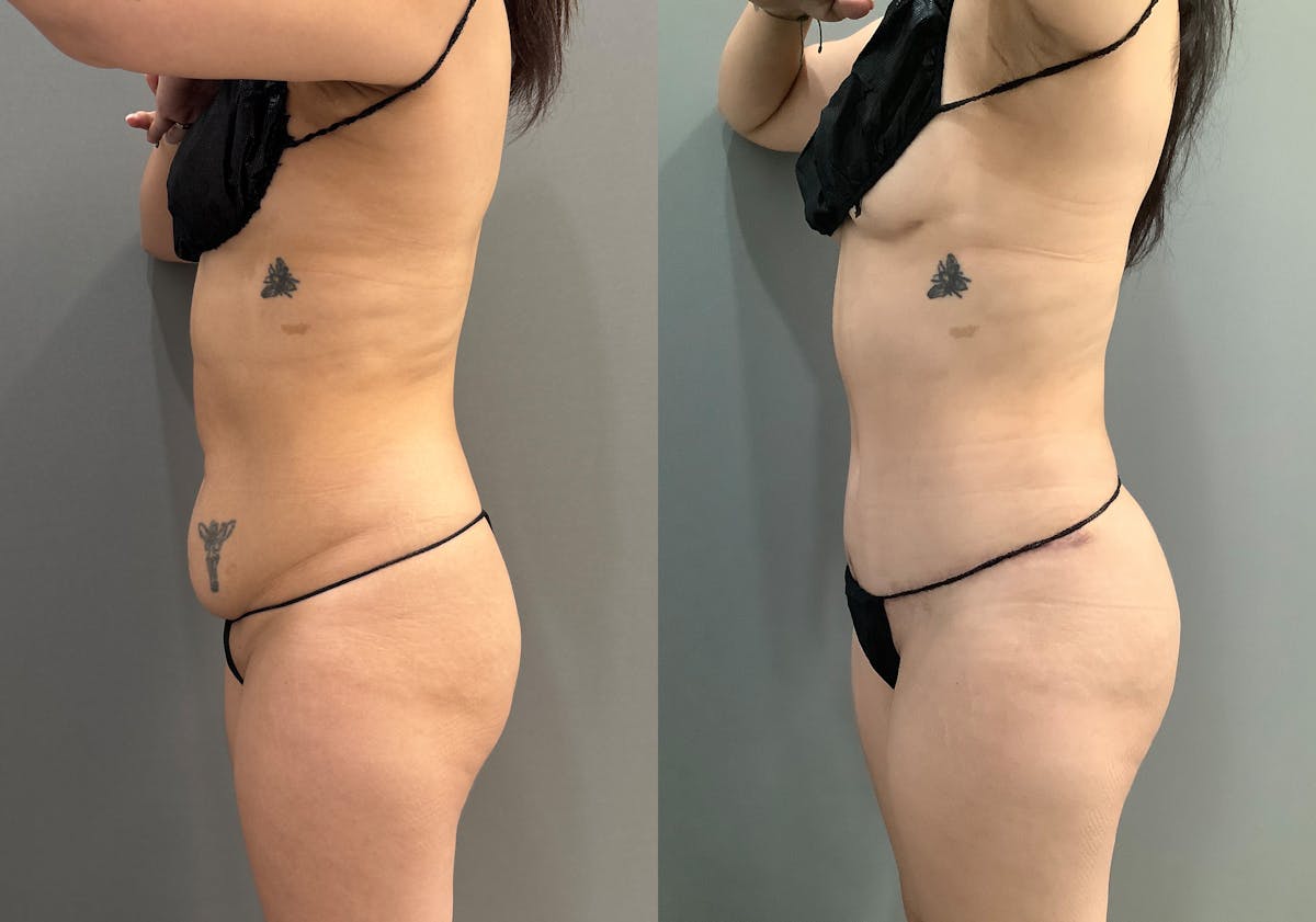 Liposuction Before & After Gallery - Patient 314443 - Image 5