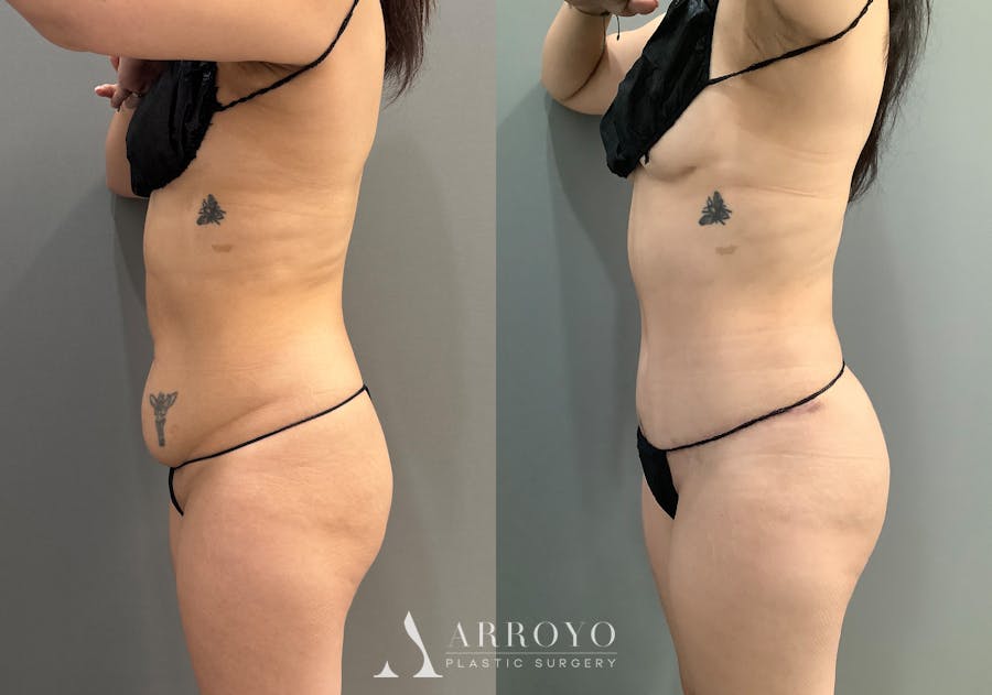 Liposuction Before & After Gallery - Patient 314443 - Image 5